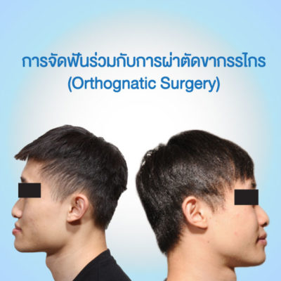 การผ่าตัดขากรรไกรร่วมกับการจัดฟัน (Orthognatic Surgery) | Bidc คลินิกทำฟัน