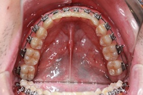 orthodontic surgery after