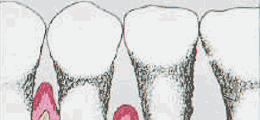 โรคเยื่อหุ้มฟันอักเสบ Periodontitis