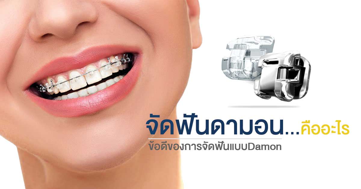 ติดเหล็กจัดฟันด้านใน