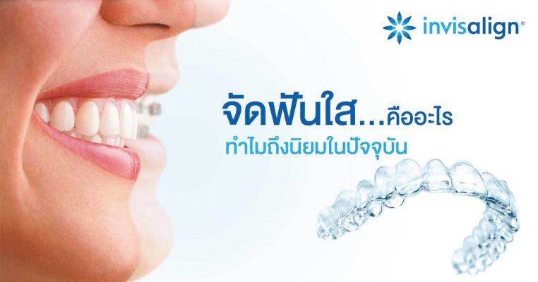 ราคาจัดฟันใส Invisalign