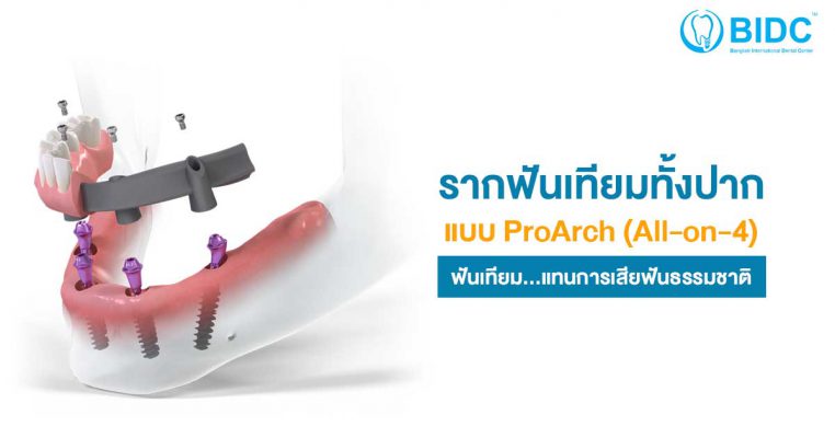 รากฟันเทียม ProArch All on 4
