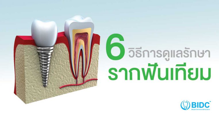 ปลูกรากฟันเทียม