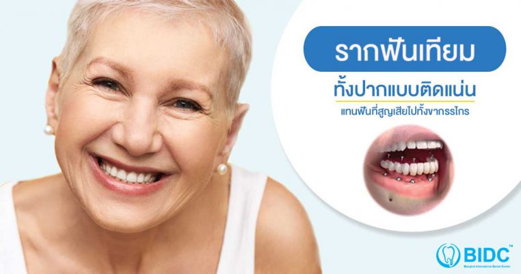 รากฟันเทียมทั้งปาก