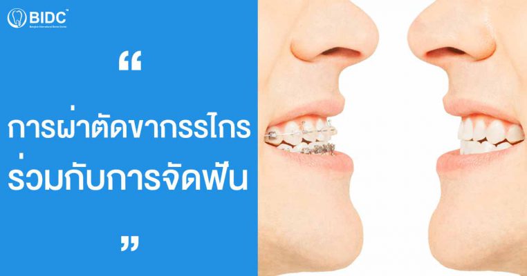 การจัดฟันร่วมกับการผ่าตัดขากรรไกร