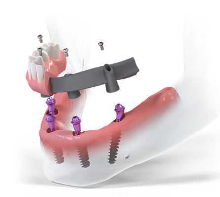 รากเทียมทั้งปากแบบ ProArch