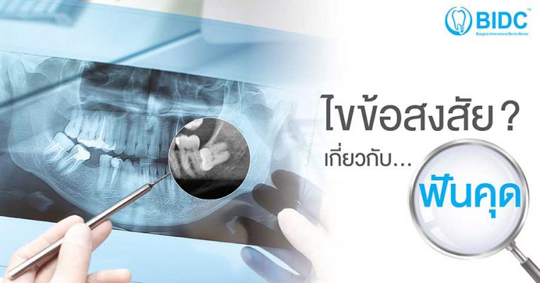 ฟันคุด