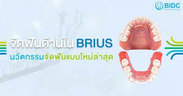 Brius จัดฟันด้านใน