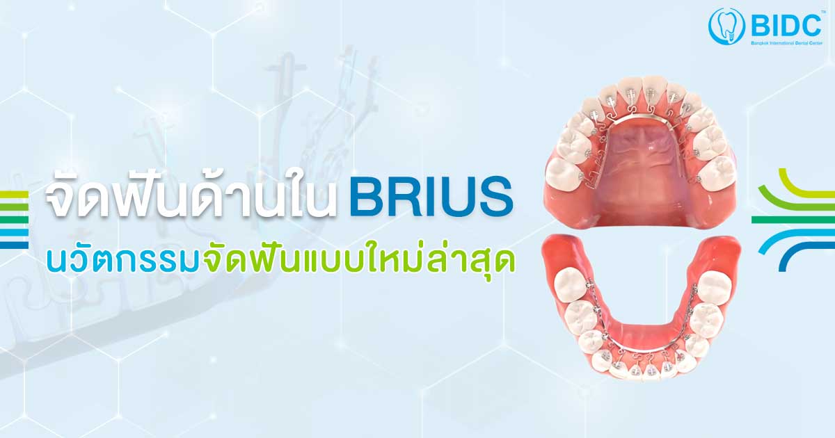 จัดฟันด้านในแบบใหม่ Brius เจ็บน้อย เสร็จเร็ว ไม่เห็นเครื่องมือดัดฟัน