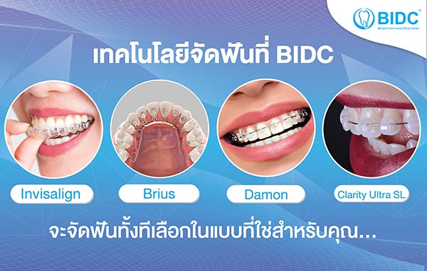 จัดฟัน แบบไหนเห็นผลดีที่สุด ดัดฟันครั้งแรกต้องจ่ายเท่าไร - จัดฟันกับ Bidc