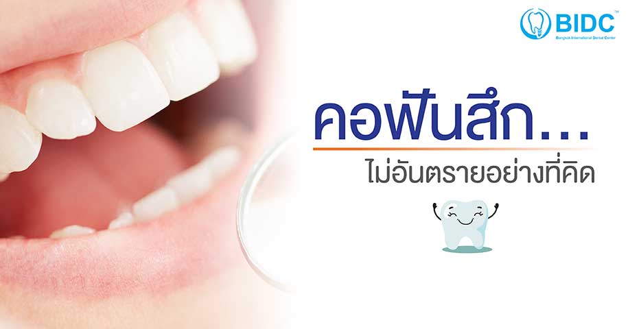 คอฟันสึก