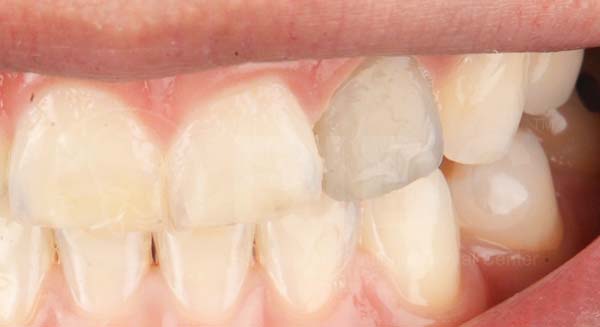 ลักษณะของอาการฟันตาย