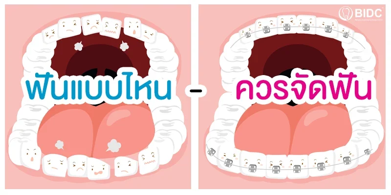 ฟันแบบไหนควรดัดฟัน