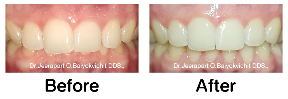 เคสจัดฟันแบบใส Invisalign Go