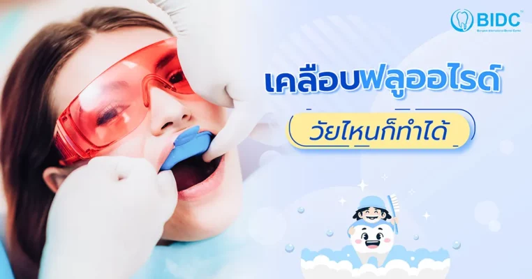 เคลือบฟลูออไรด์