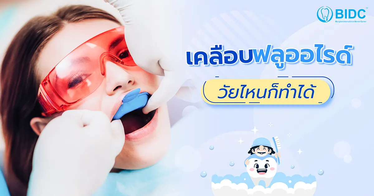 เคลือบฟลูออไรด์