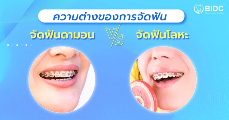 จัดฟันดามอน จัดฟันโลหะ