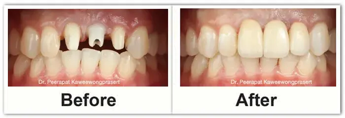 รีวิวการทำรากฟันเทียม Real Review