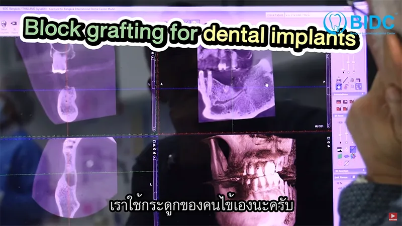 ปลูกกระดูกทำยังไง